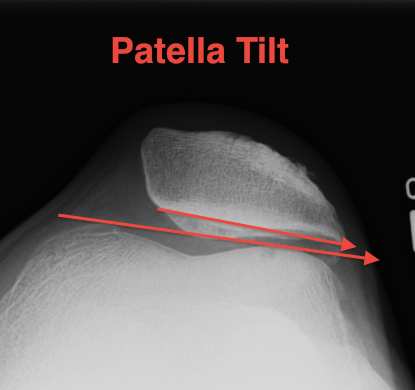 Patella Tilt Laurin View